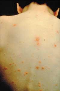 răsaduri din vene varicoase